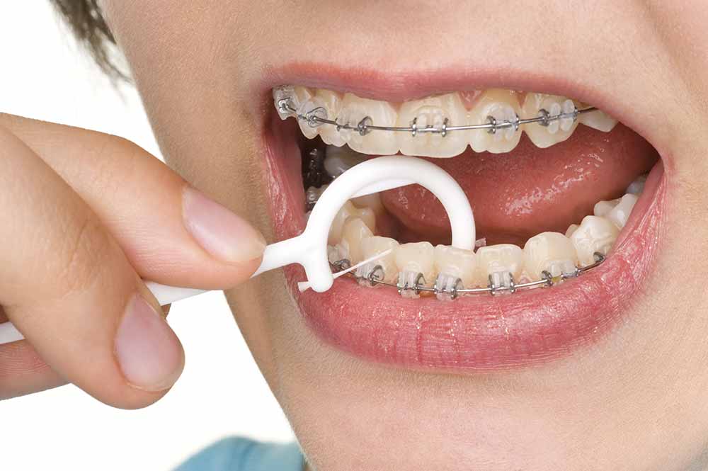 caring for braces