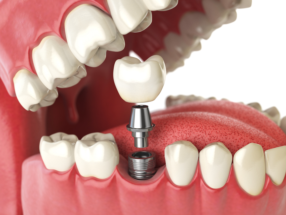 dental-implant-diagram